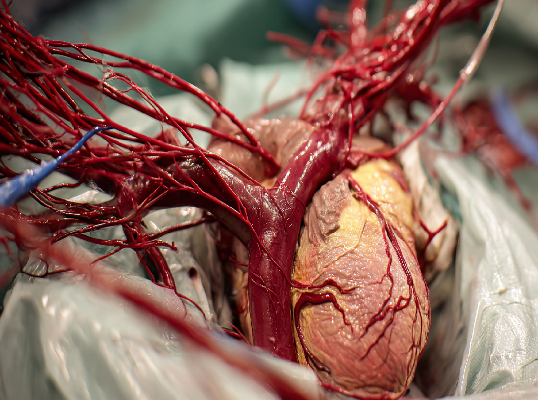 Синдром артериовенозного шунтирования