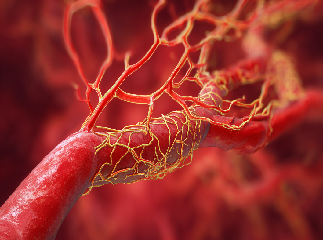 Синдром артериовенозного шунтирования
