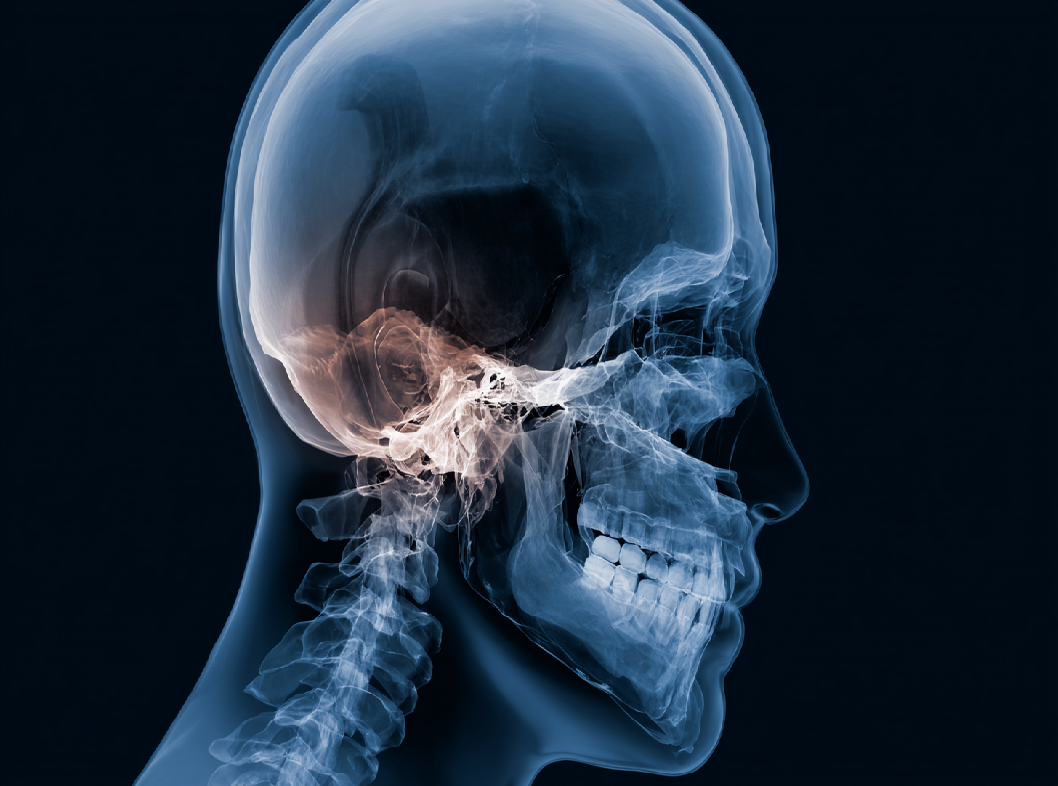 Перелом височной кости