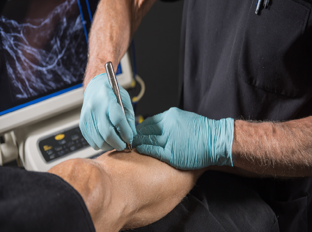 УЗДС вен нижних конечностей