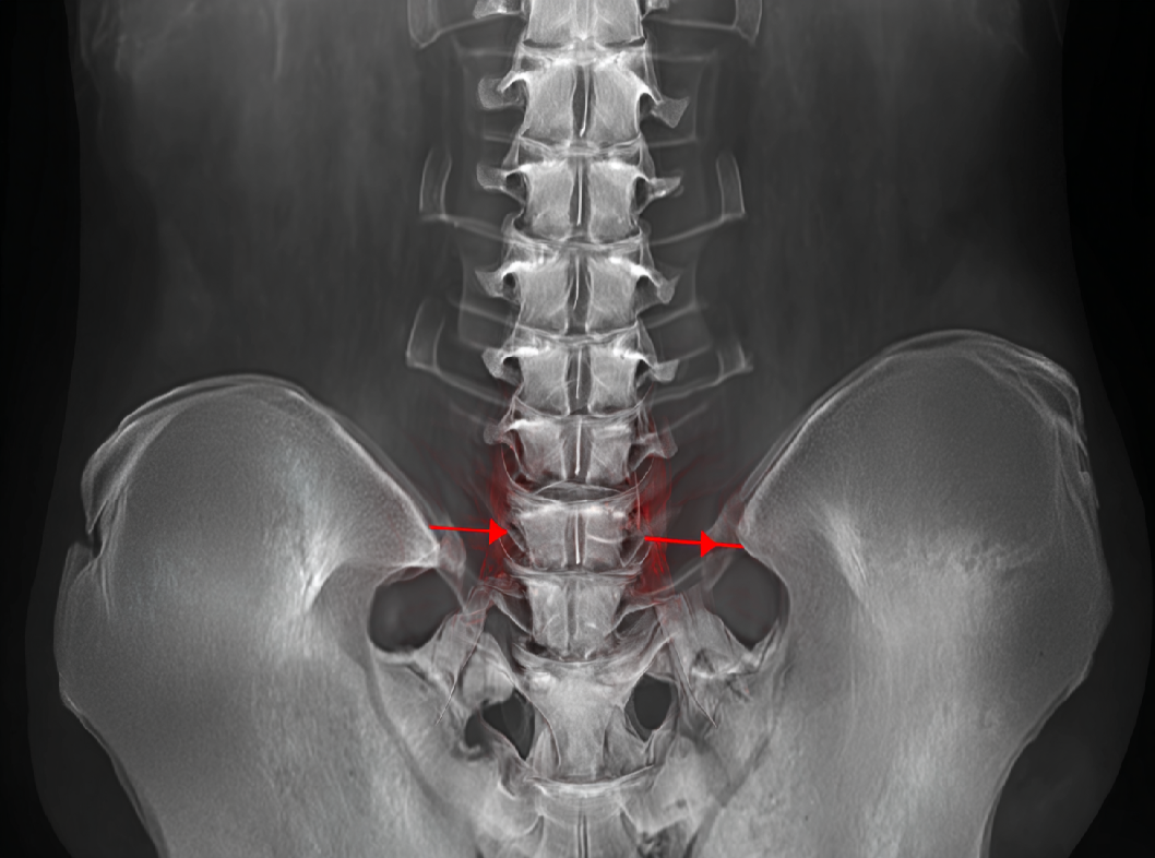 Перелом крестца