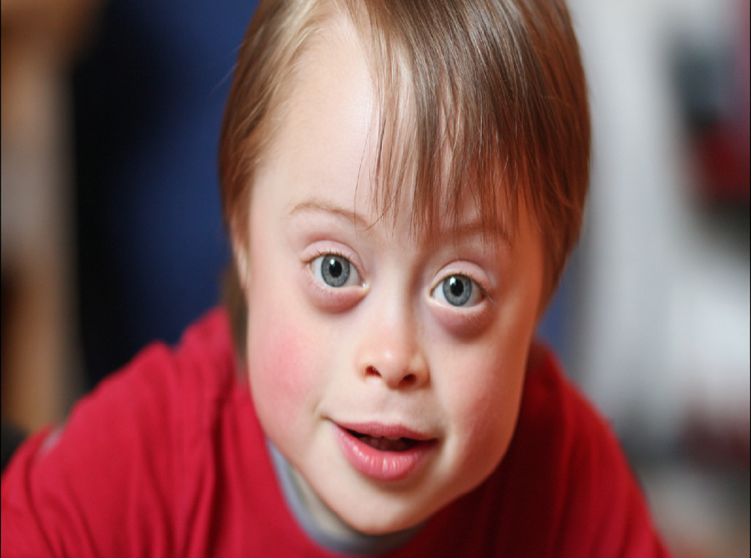 Синдром Дауна