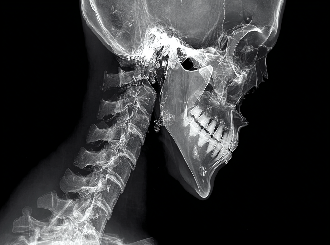 Перелом атланта