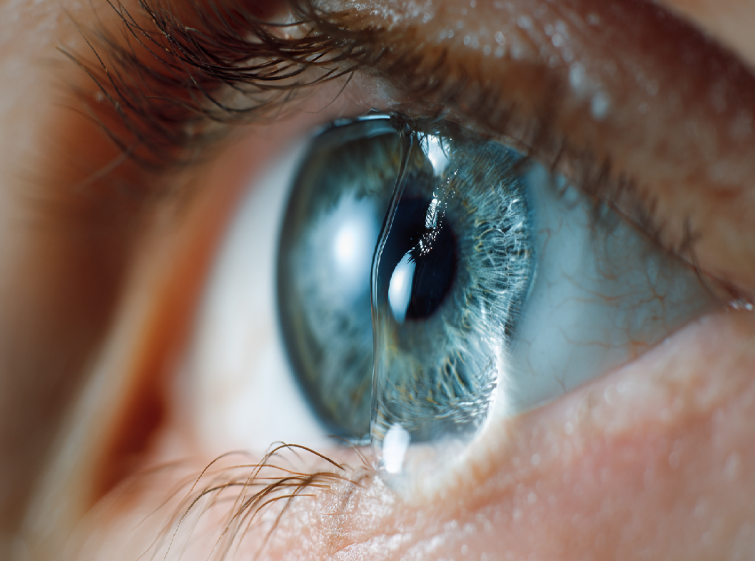 Острый гидропс роговицы