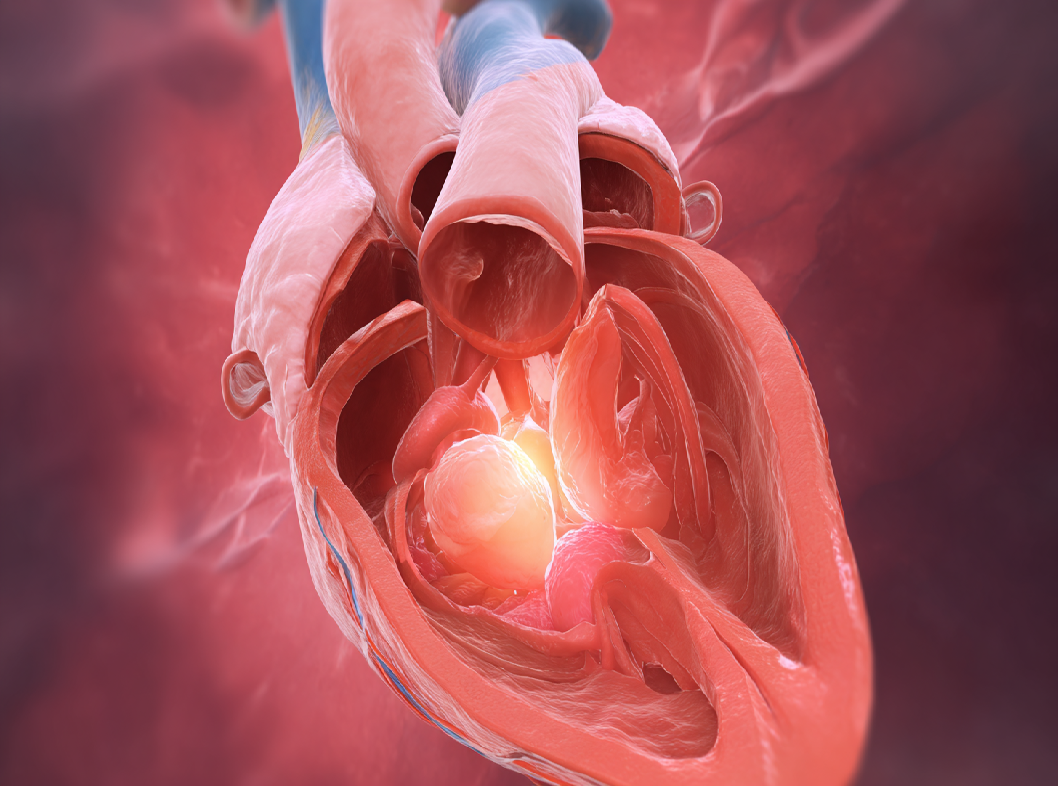 Пролапс митрального клапана