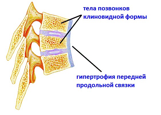клиновидные позвонки