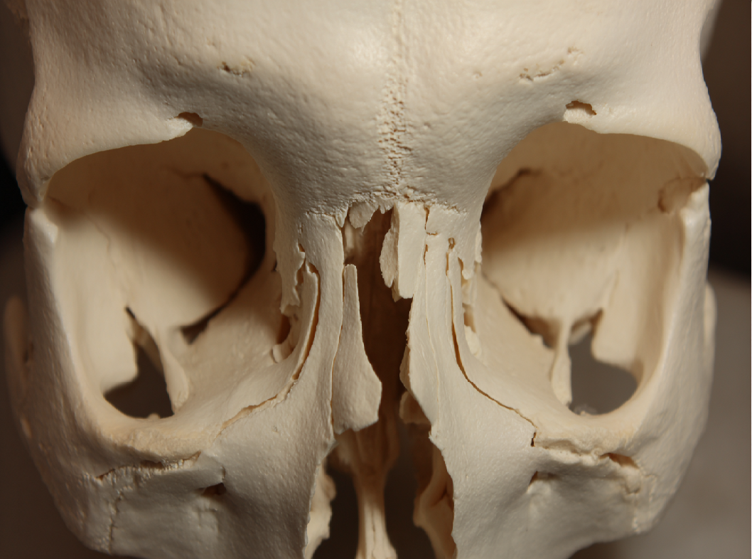 Перелом клиновидной кости