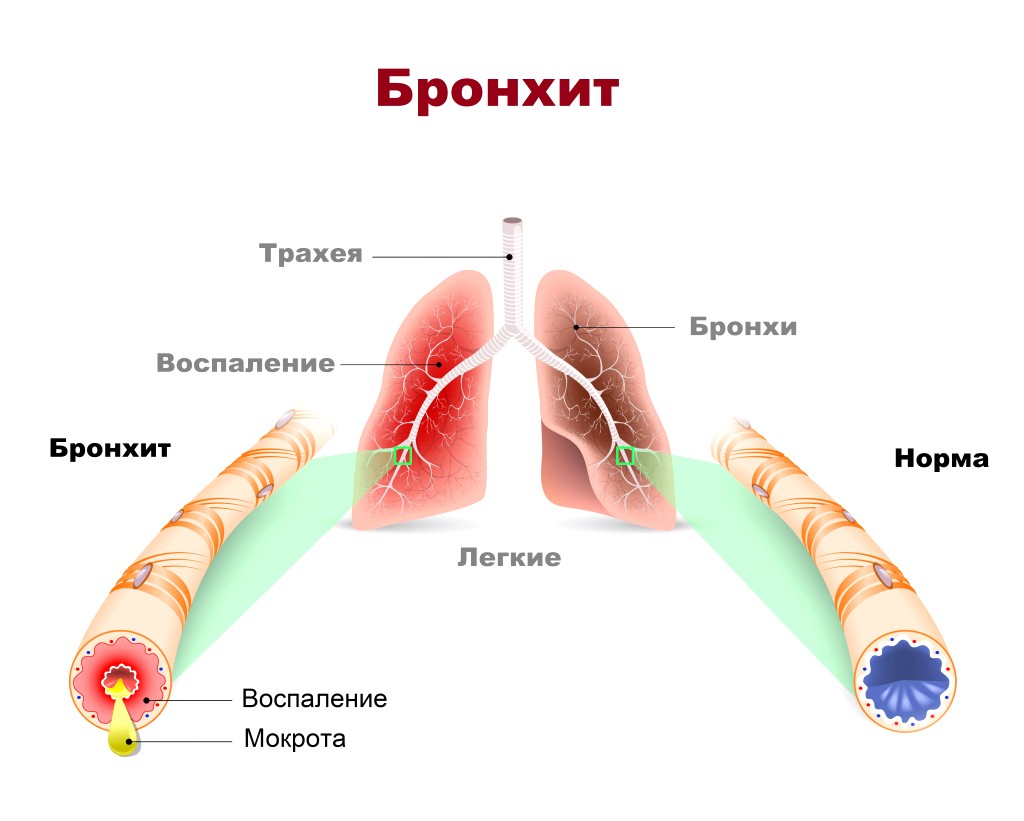 острый бронхит