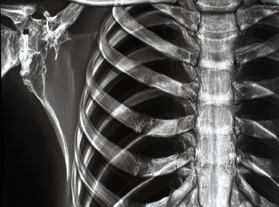 Переломы рёбер