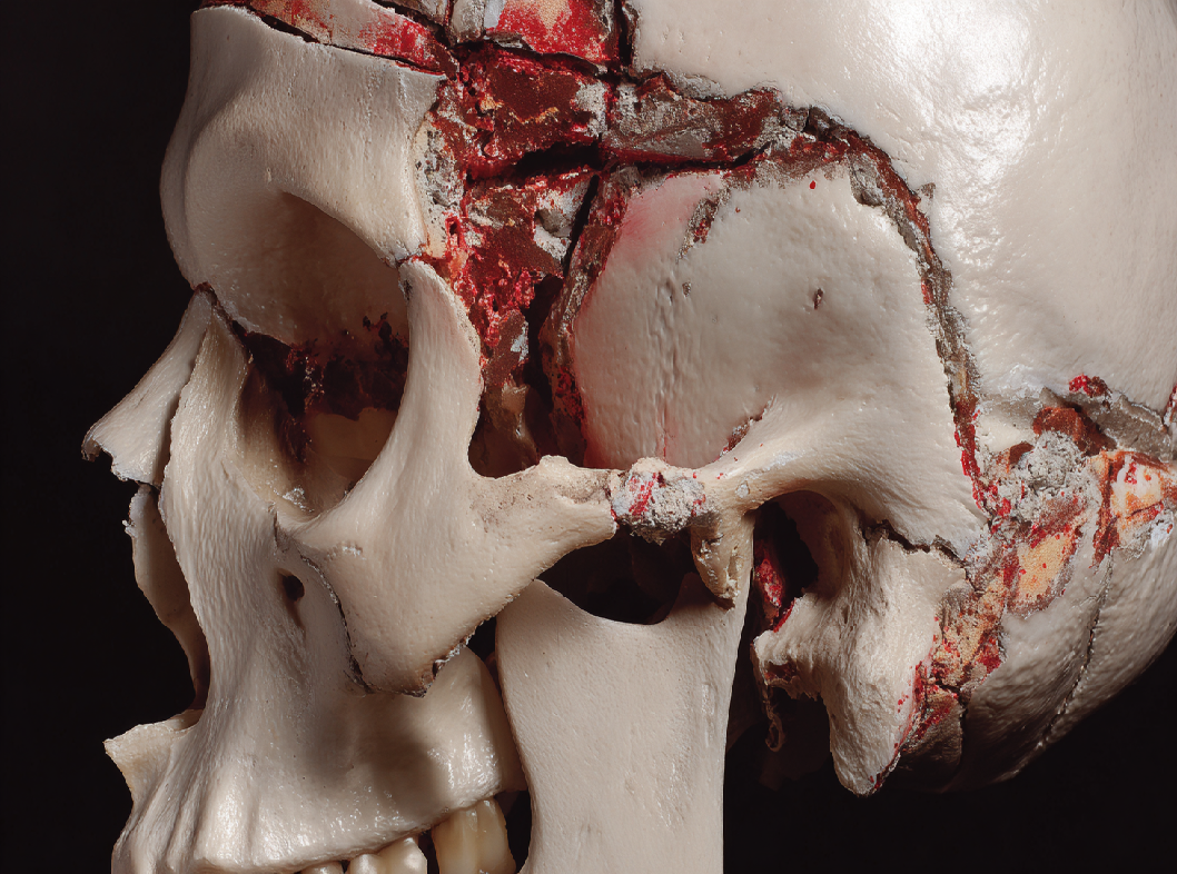 Перелом затылочной кости