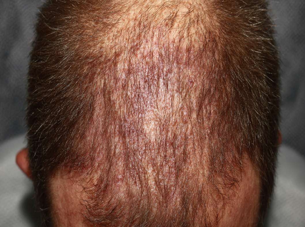 Фолликулярный гиперкератоз