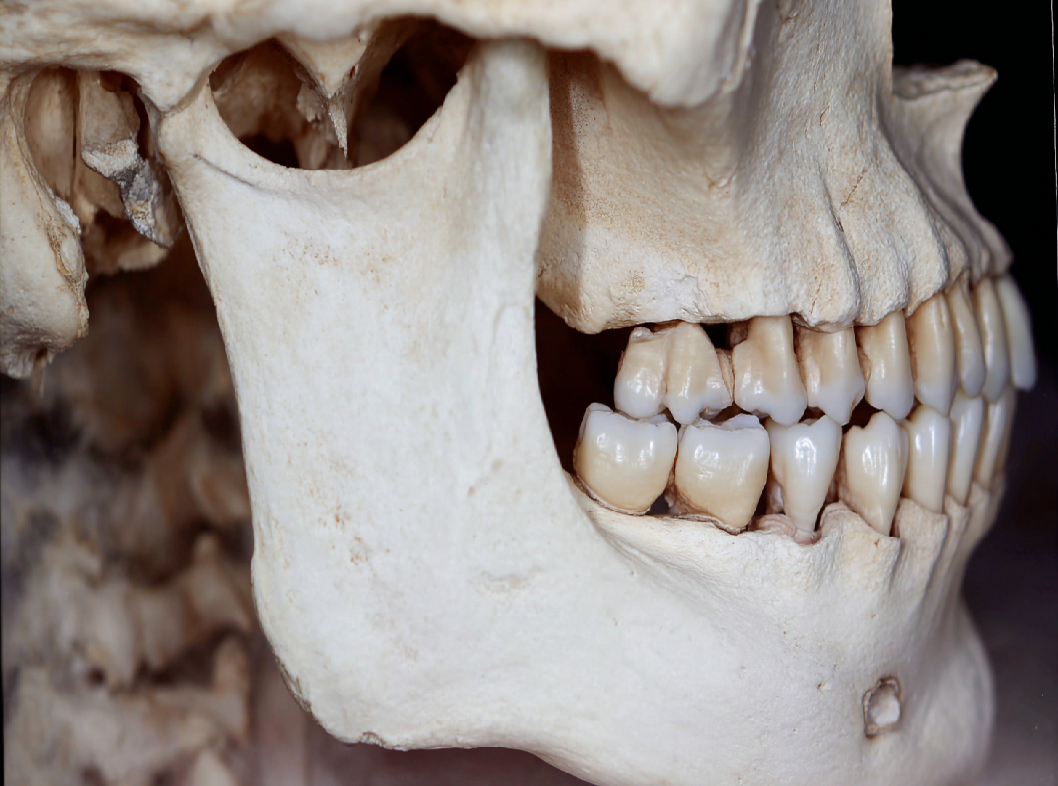 Переломы верхней челюсти