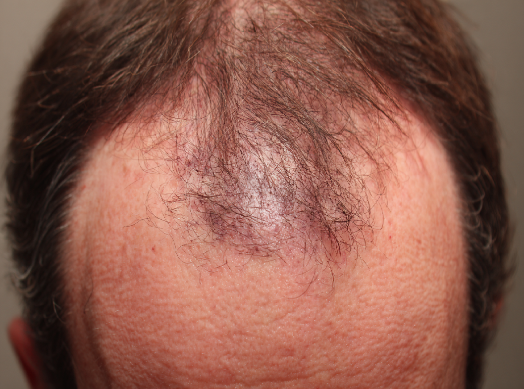 Фолликулярный гиперкератоз