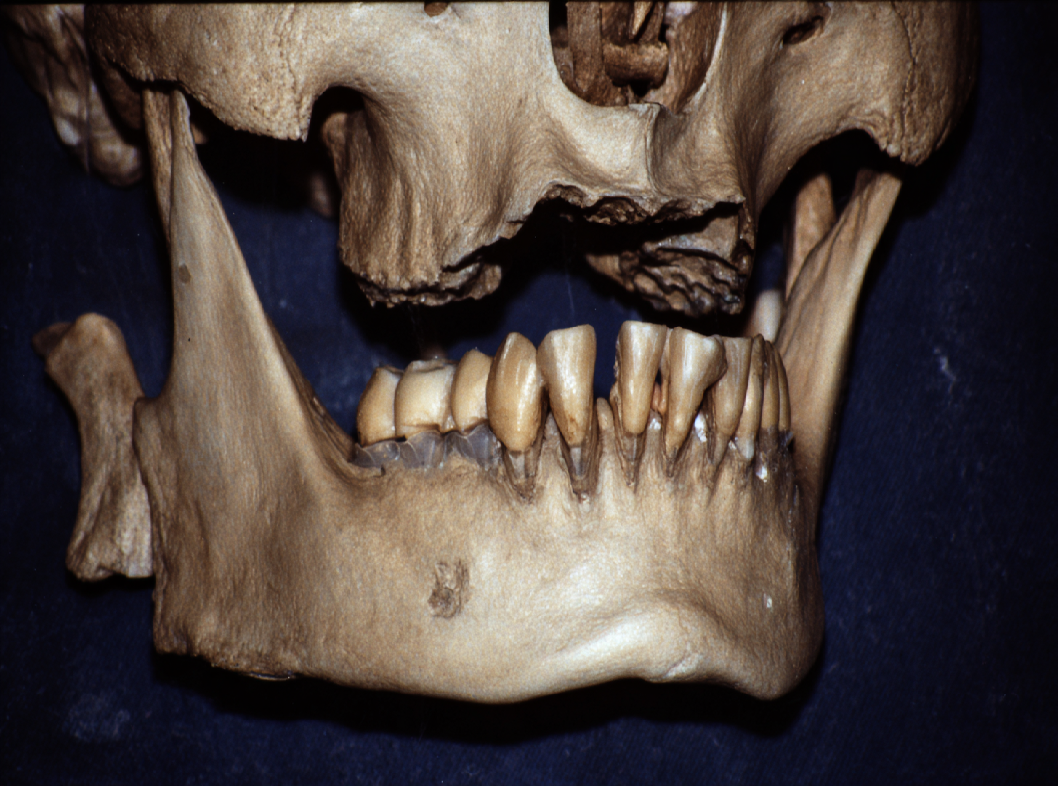 Переломы верхней челюсти