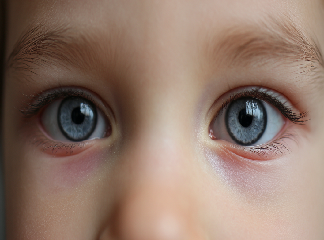 Косоглазие