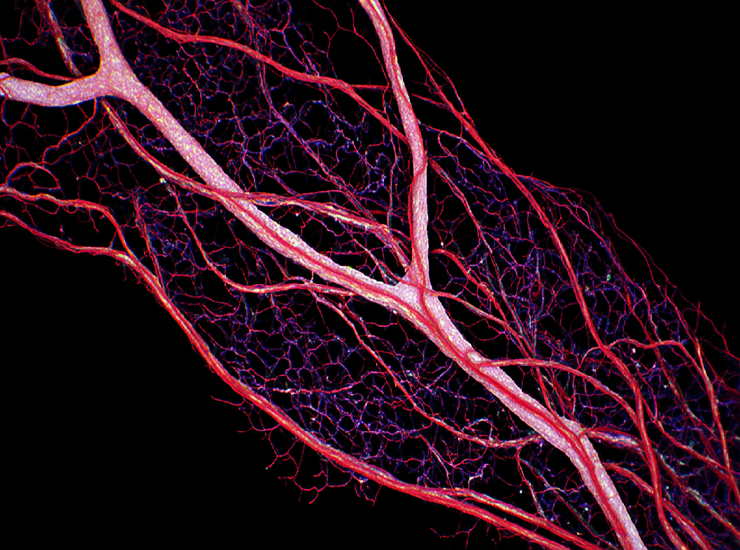 Капиллярная ангиодисплазия