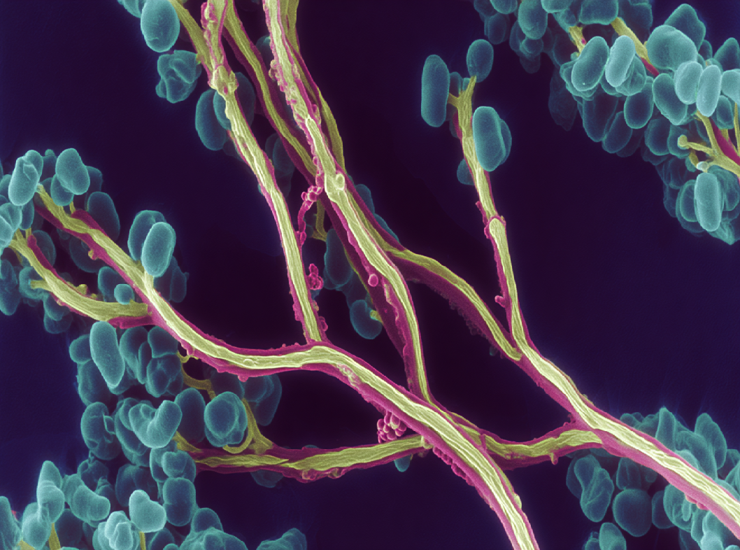 Капиллярная ангиодисплазия
