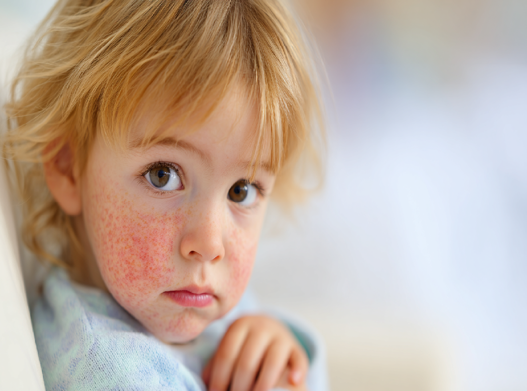Атопический дерматит у детей
