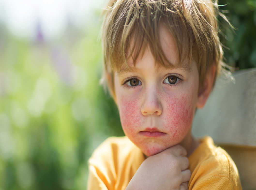 Атопический дерматит у детей