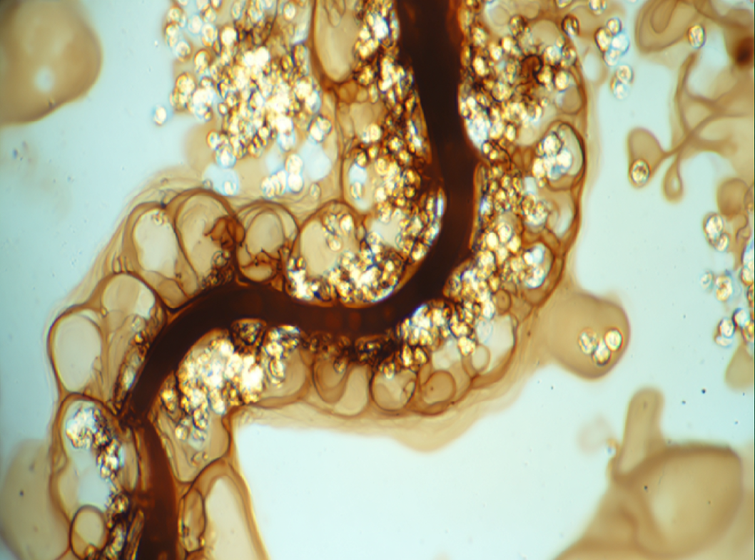 Ангиодисплазия кишечника