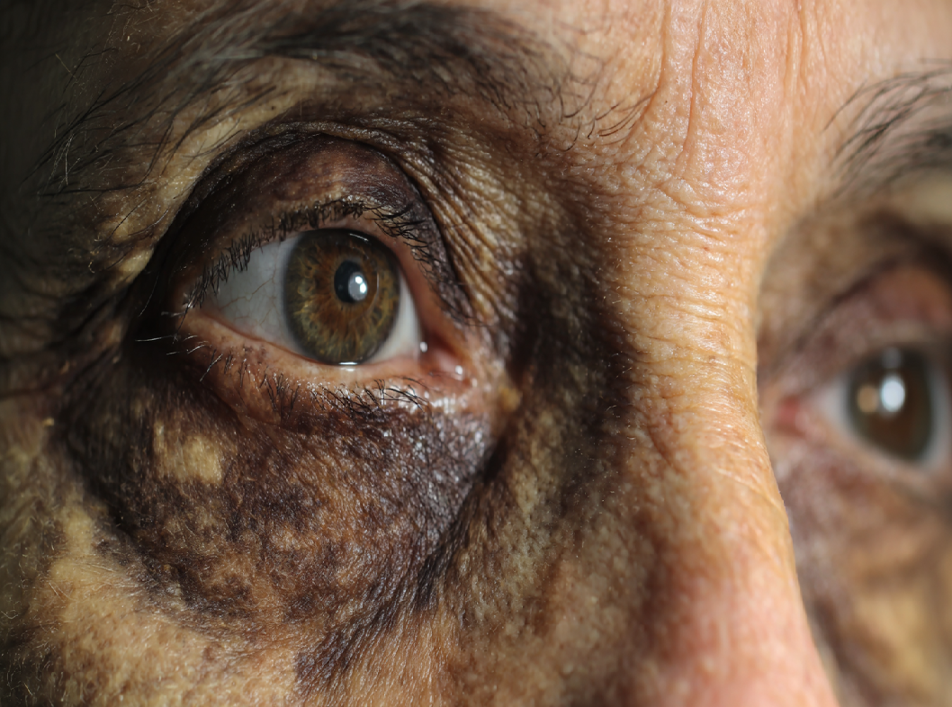 Болезнь Кароли