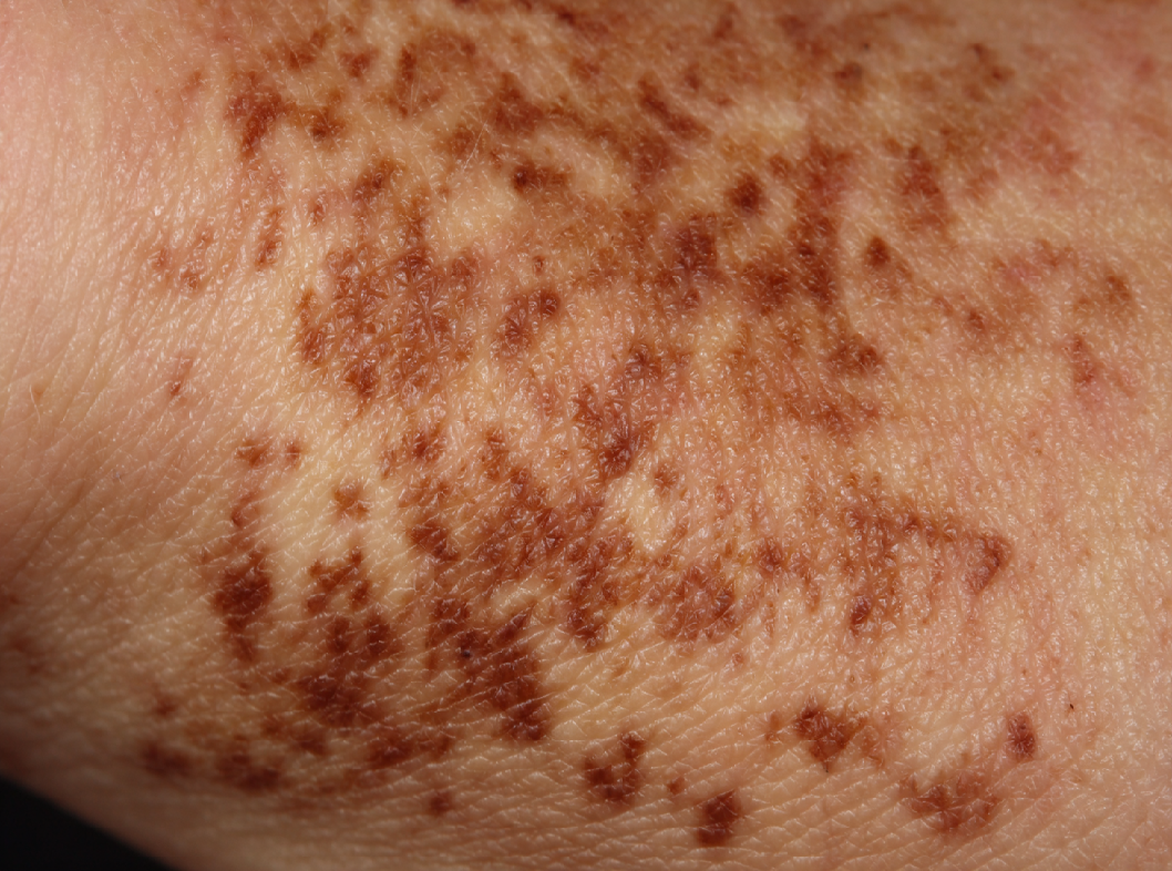 Болезнь Кароли