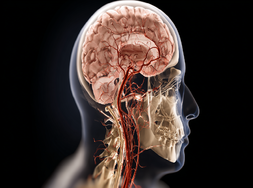 Стволовой инсульт