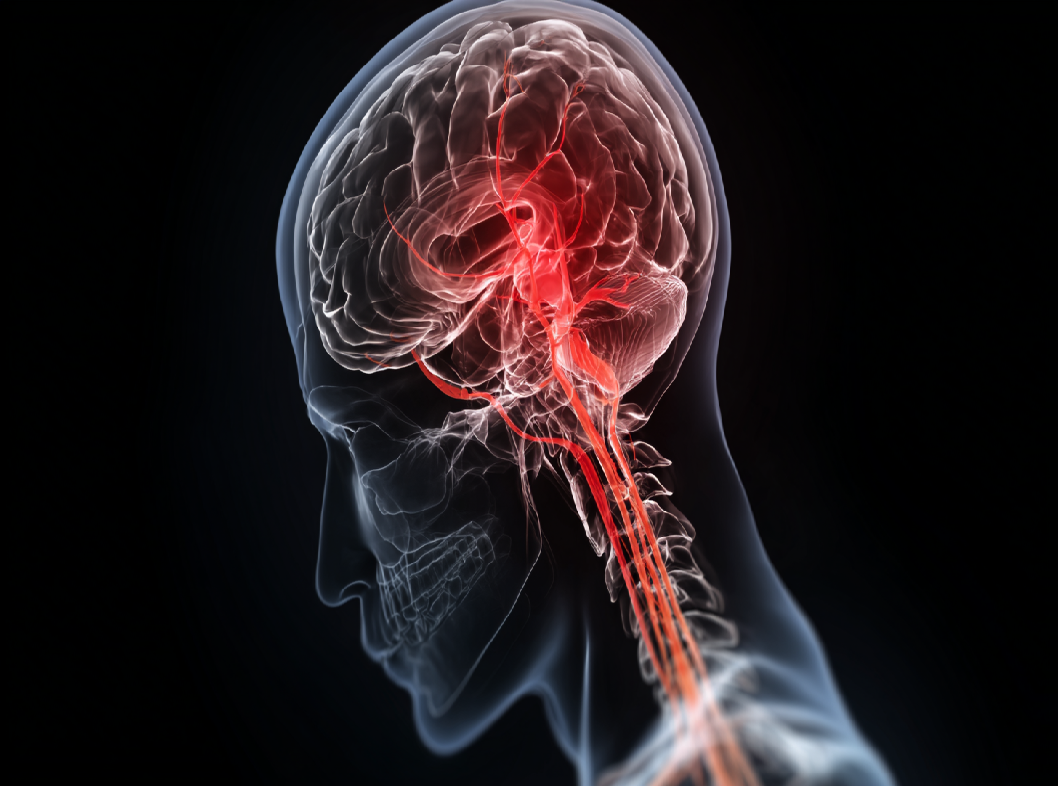 Стволовой инсульт