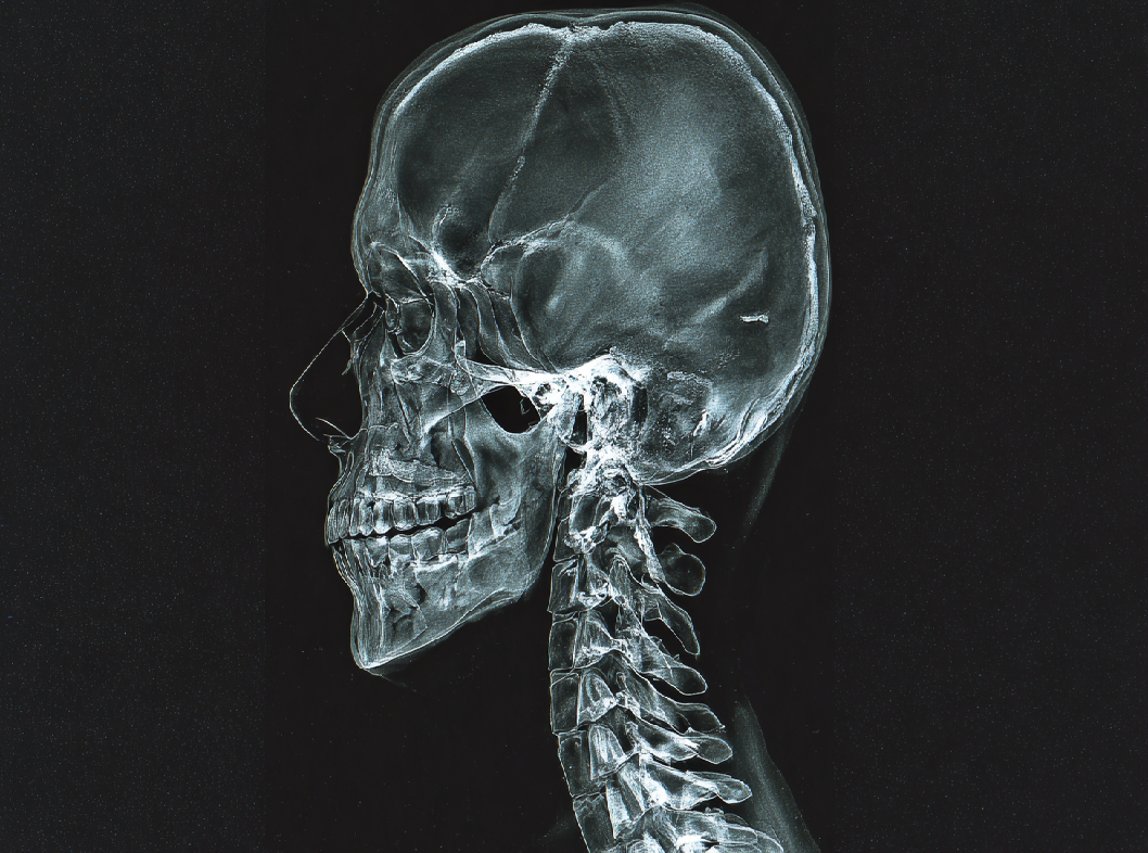 Синдром черепно-шейного перекоса