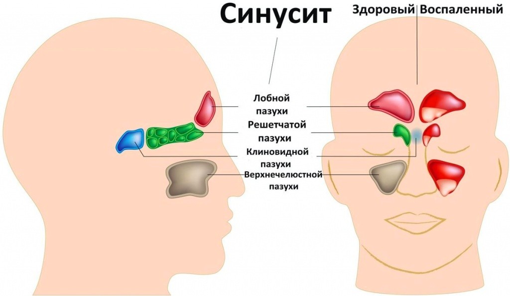 синусит