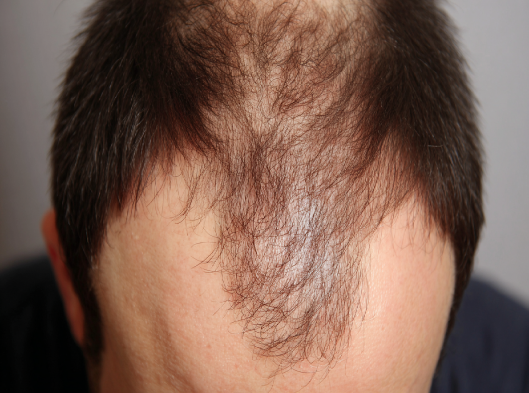 Очаговая алопеция