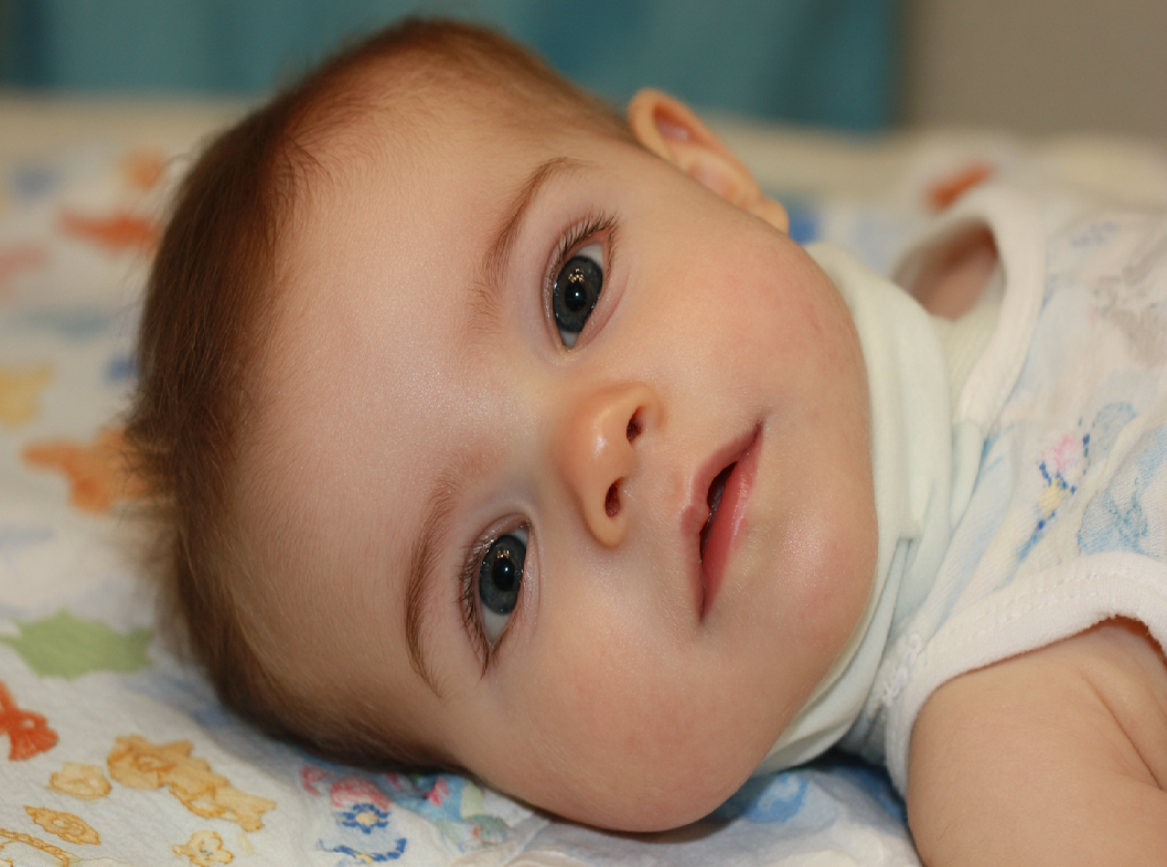 Врожденный мышечный тортиколлис