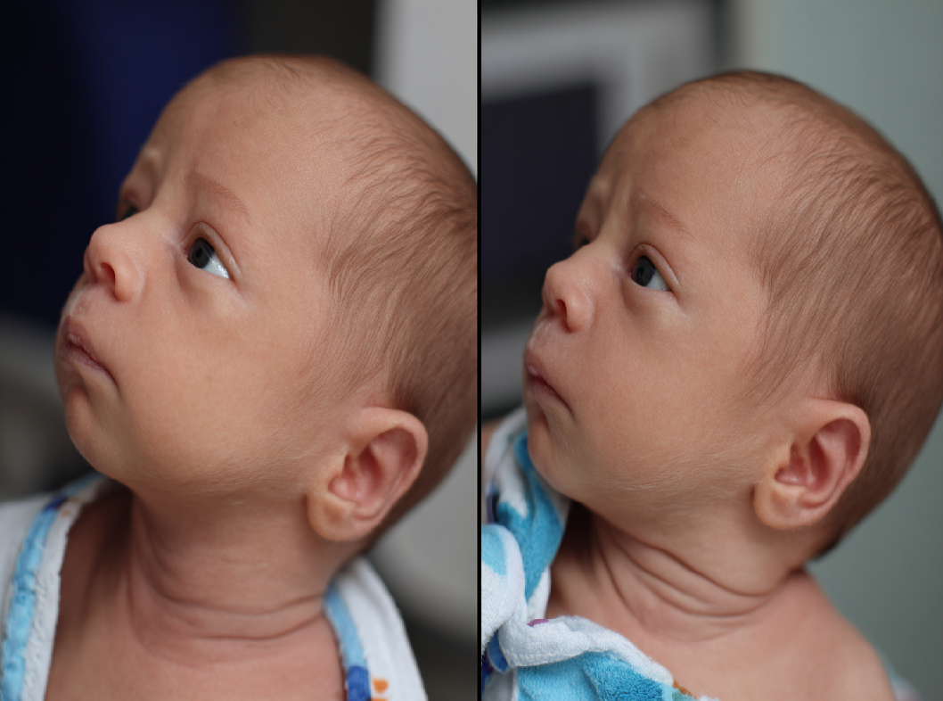 Врожденный мышечный тортиколлис