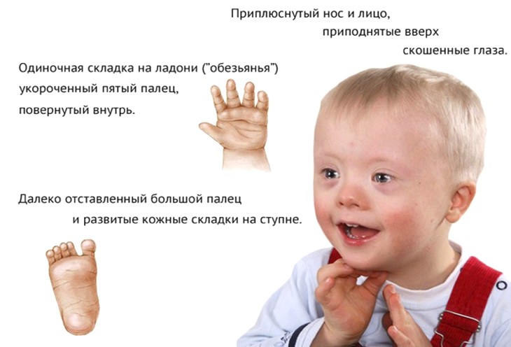 синдром Дауна
