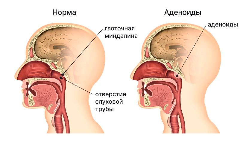 аденоиды