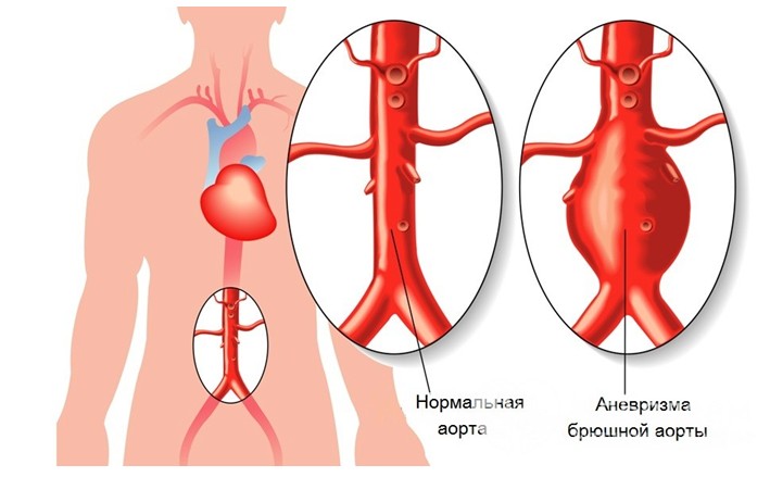 абоа