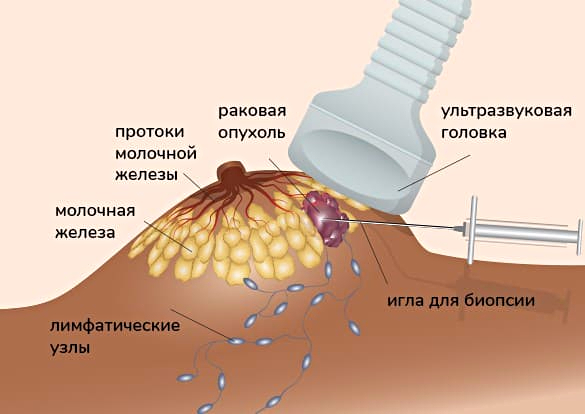 Постоянная боль в молочных железах