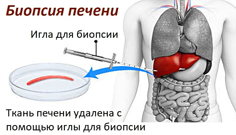 Почему повышается АЛТ в крови