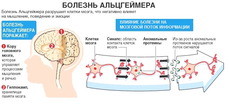 альцгеймера