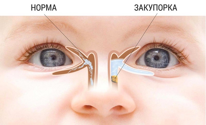 дакриоцистит 
