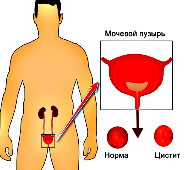 боль при цистите у мужчин