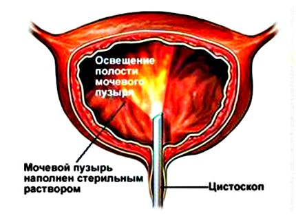 проведение цистоскопии