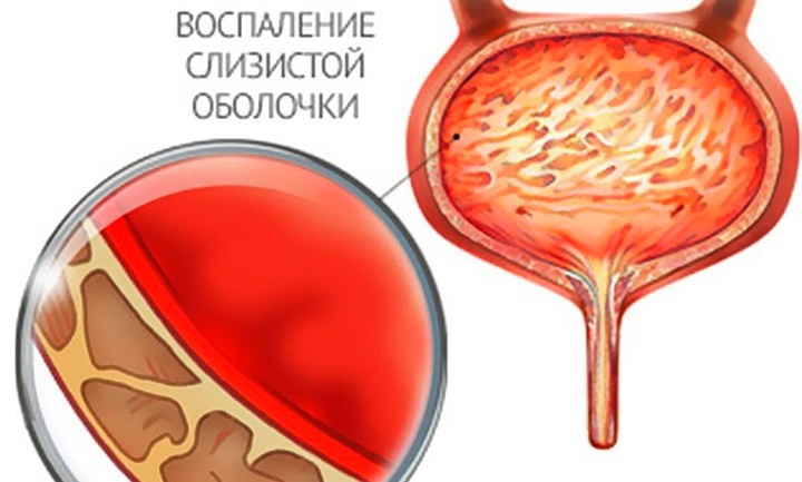 цистит
