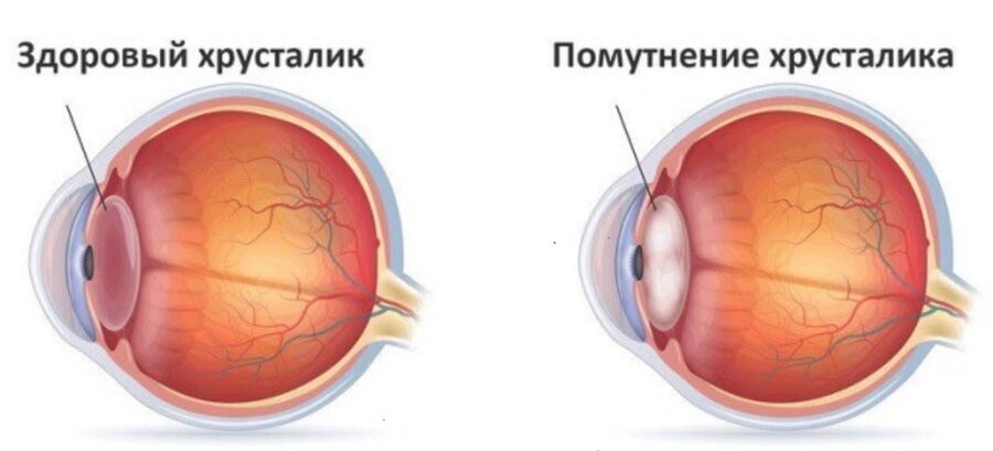 Катаракта
