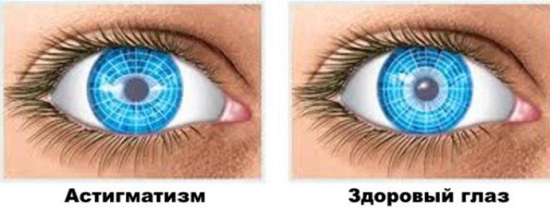 астигматизм