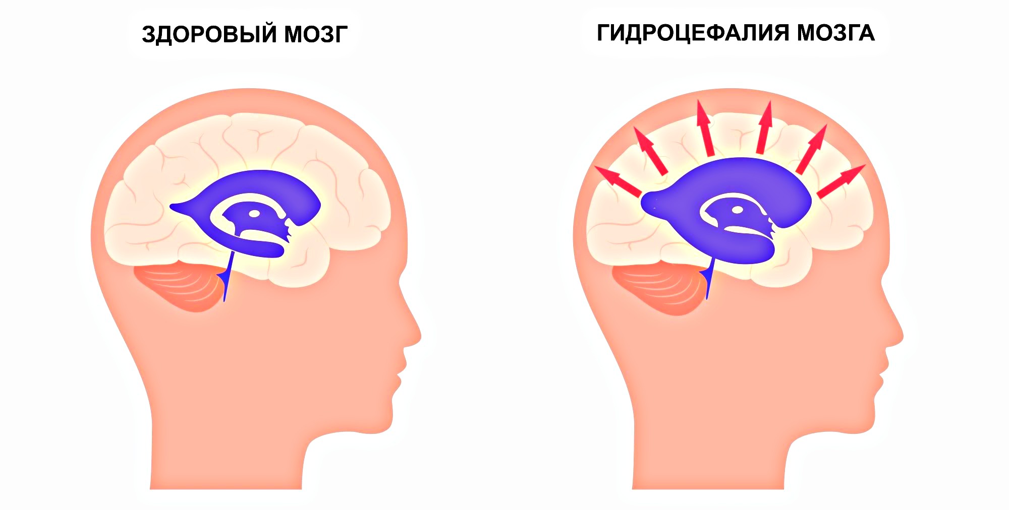 симптомы водянки головного мозга