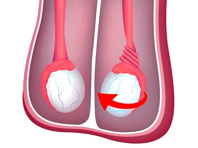 Перекрут яичка