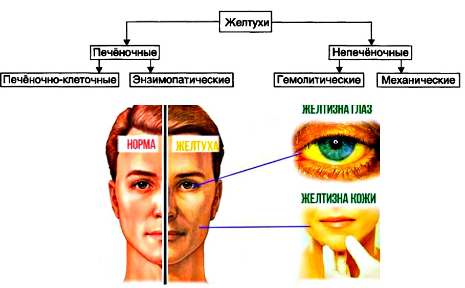 диагностика желтухи