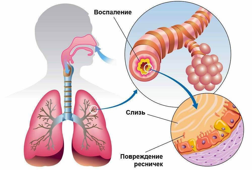 бронхит
