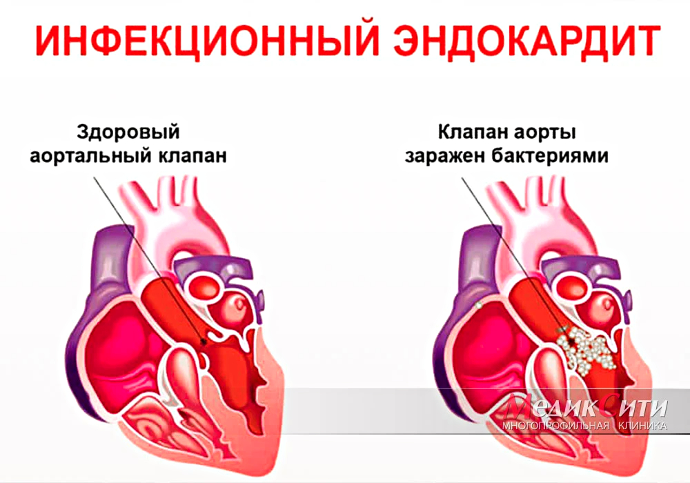 Ревматическая лихорадка